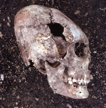 Deformed skull by bandage in youth